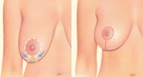 Breast Lift Example - 4