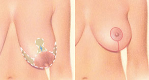 Breast Lift Example - 5
