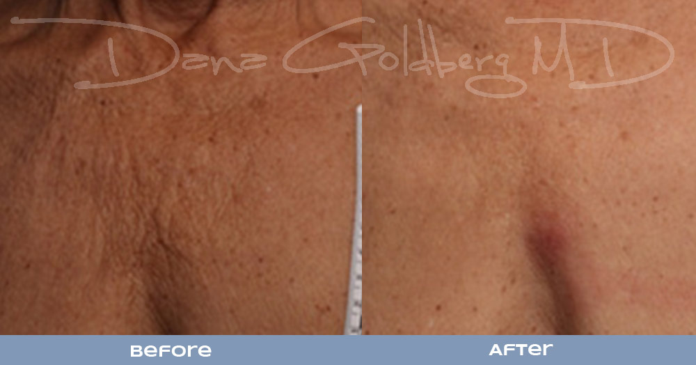 Non-Surgical Ultherepy