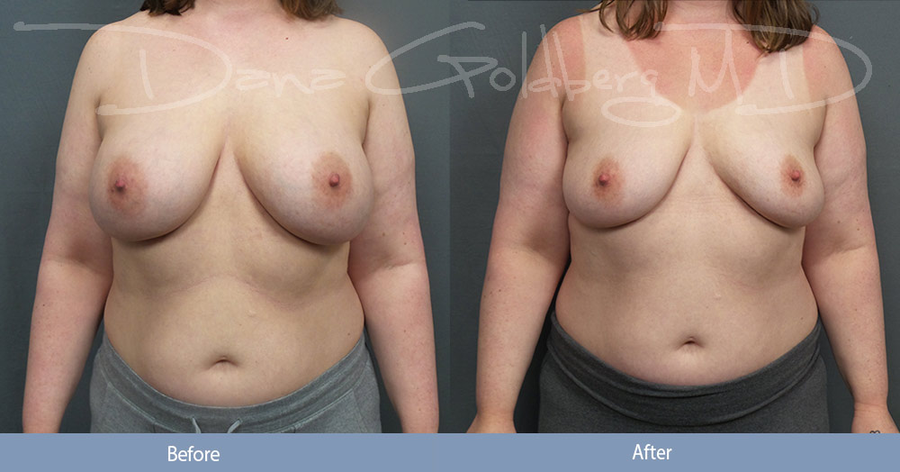 Breast Implant Removal Gallery Photo