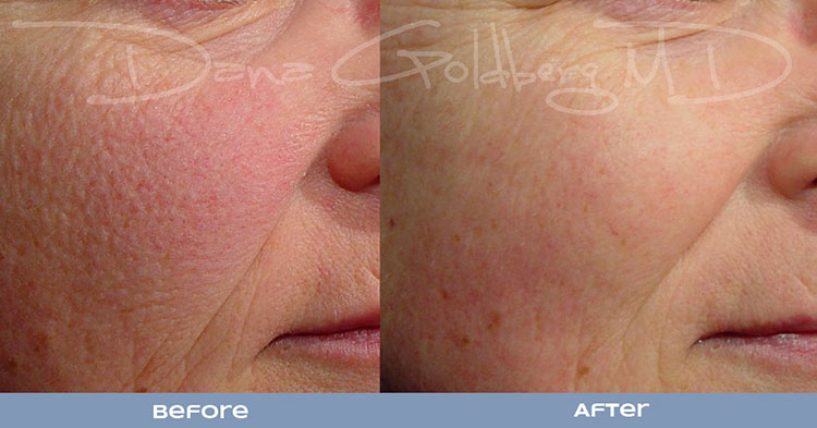 Aging Before & After, Laser Genesis