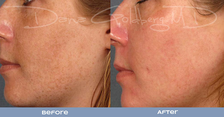 Limelight Laser Services