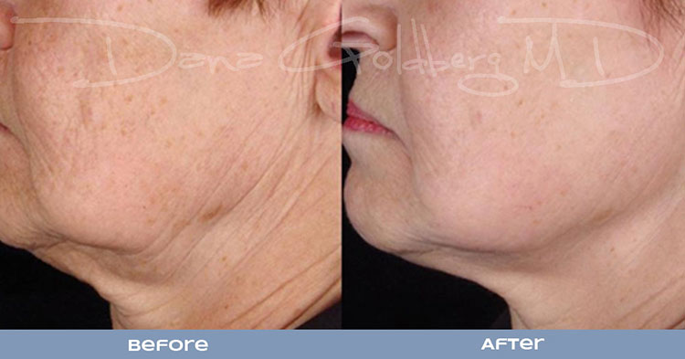 Titan Laser Treatment 