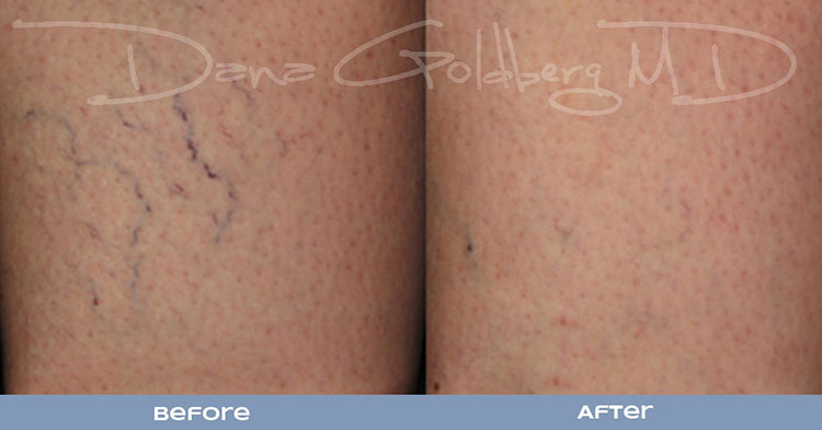 Sclerotherapy