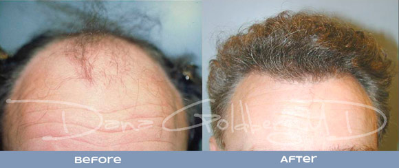 Another Hair Transplant Before and After Patient